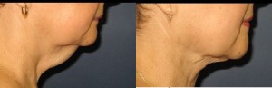 Laser Neck Lift