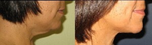 Laser Neck Lift New York City