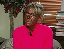 Tanorexic