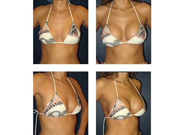 breast enhancement hartford Teens with c cup tits