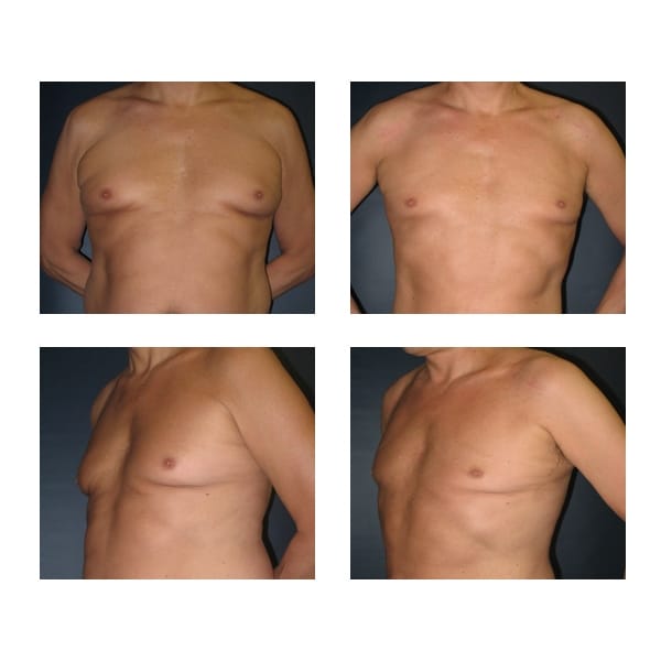 Think, that Atlanta breast reduction scarless Authoritative message Atlanta breast reduction scarless opinion