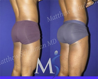 BBL before and after male BBL before and after male