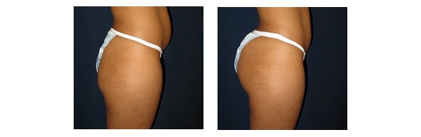 Buttock Augmentation and Lift 1