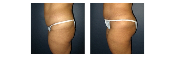 Buttock Augmentation and Lift 10