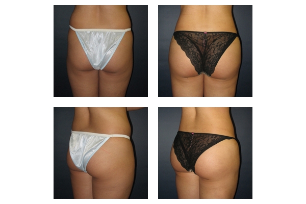 Buttock Augmentation and Lift 12