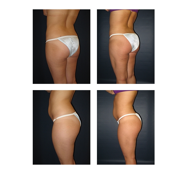 Buttock Augmentation and Lift 13