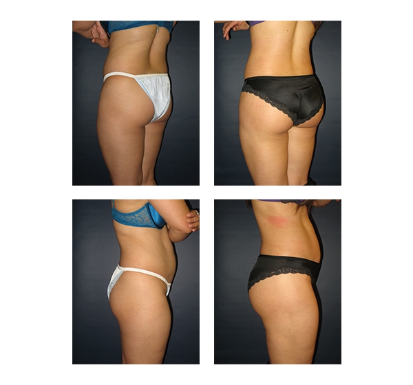 Buttock Augmentation and Lift 14