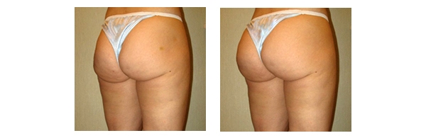 Buttock Augmentation and Lift 3