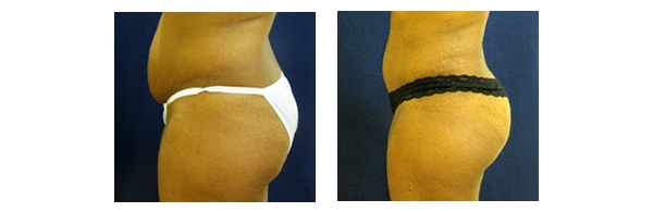 Buttock Augmentation and Lift 4