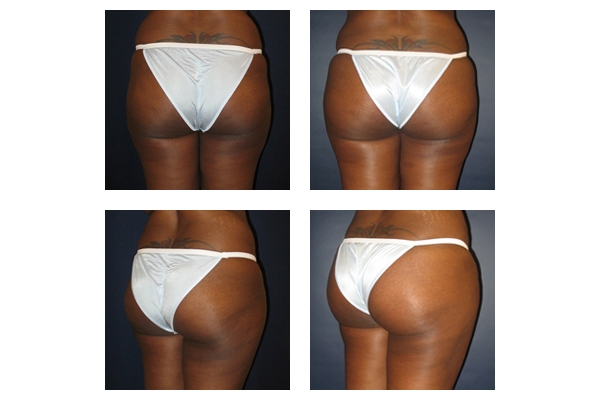 Buttock Augmentation and Lift 6