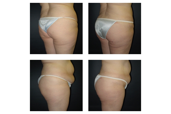 Buttock Augmentation and Lift 7