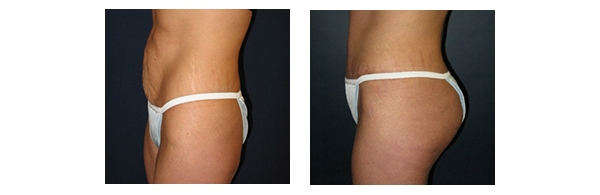 Buttock Augmentation and Lift 8
