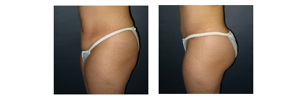 Buttock Augmentation and Lift 9