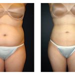 Liposuction New York City