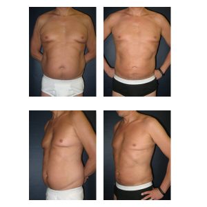 Male Liposuction 