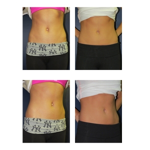 Tummy Tuck to Lose Weight