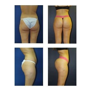 Brazilian Butt Lift NYC thumb