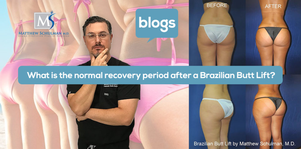 Normal Recovery Period After a Brazilian Butt Lift