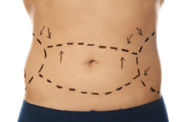 360 Lipo Without Tummy Tuck Cost