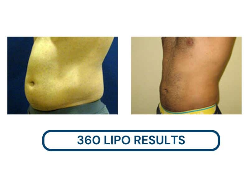 360 lipo results