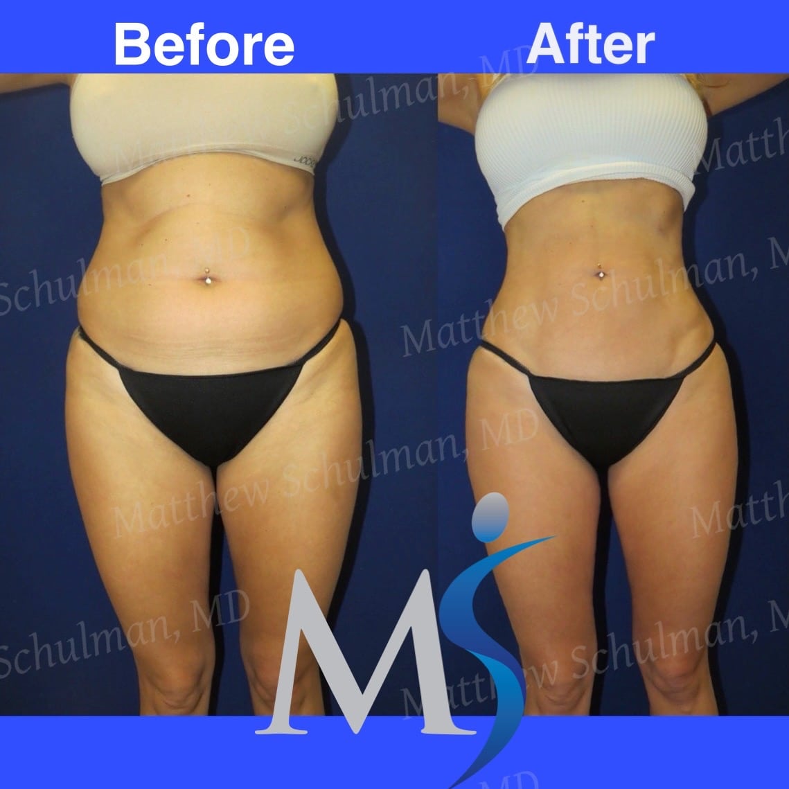 360 lipo without tummy tuck