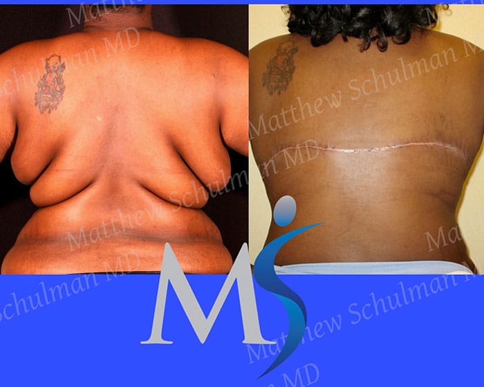 After Weight Loss Plastic Surgery NYC