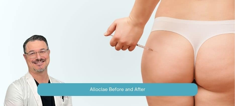 Alloclae Before and After