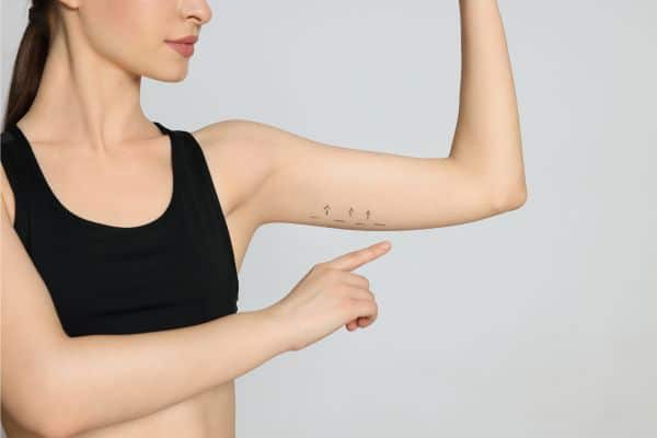 Arm Lift Scars Before And After