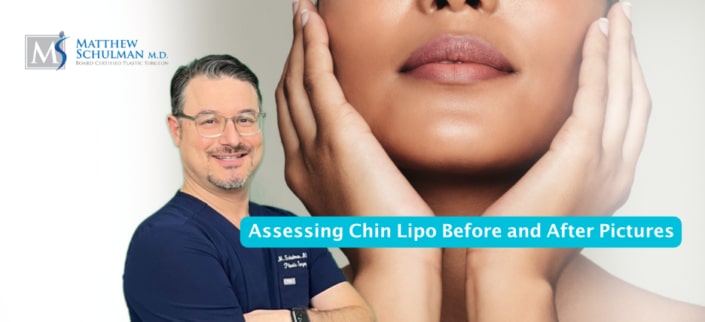 Assessing Chin Lipo Before And After Pictures