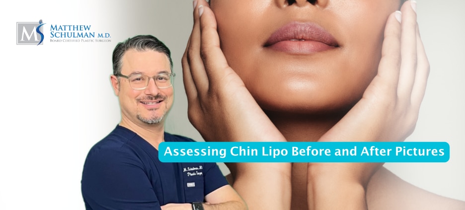 Assessing Chin Lipo Before And After Pictures