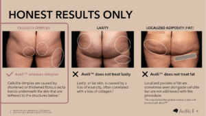 Aveli Cellulite Treatment