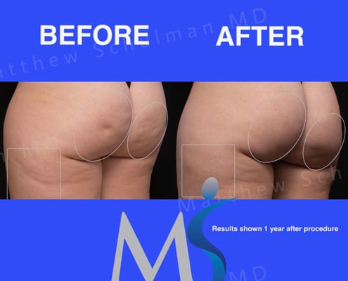 Aveli Cellulite Treatment NYC