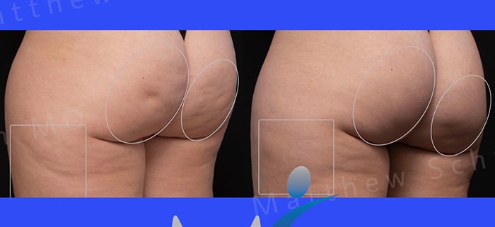 Aveli Cellulite Treatment NYC