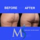 Aveli Cellulite Treatment NYC