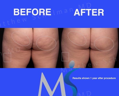 Aveli Cellulite Treatment New York