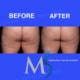 Aveli Cellulite Treatment New York