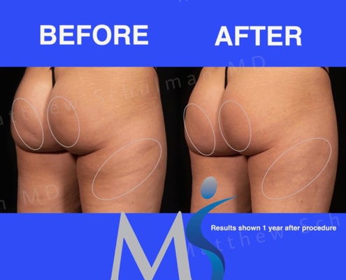 Aveli Cellulite Treatment New York City