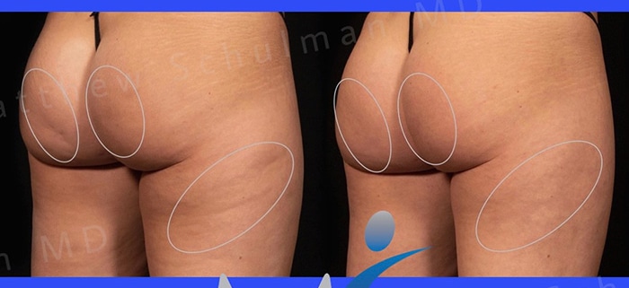 Aveli Cellulite Treatment New York City