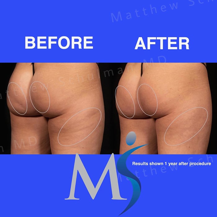 Aveli Cellulite Treatment New York City