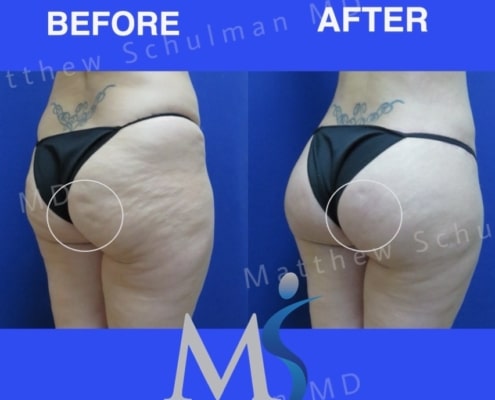 Aveli cellulite Treatment NYC Patient 5
