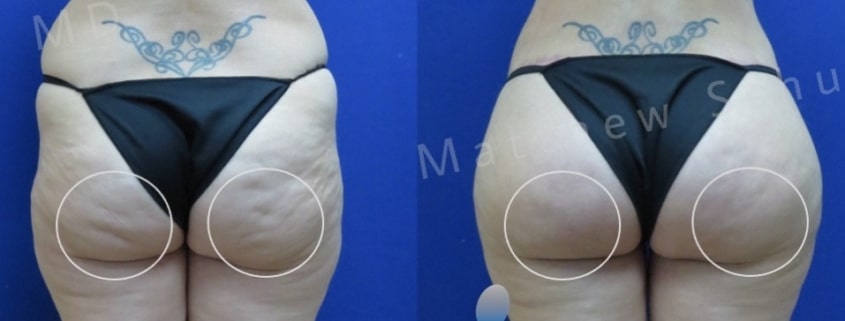 Aveli cellulite Treatment NYC Patient 6