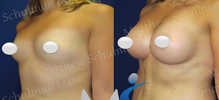 Breast Augmentation NYC