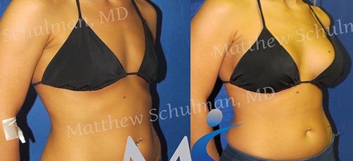 Breast Augmentation New York City