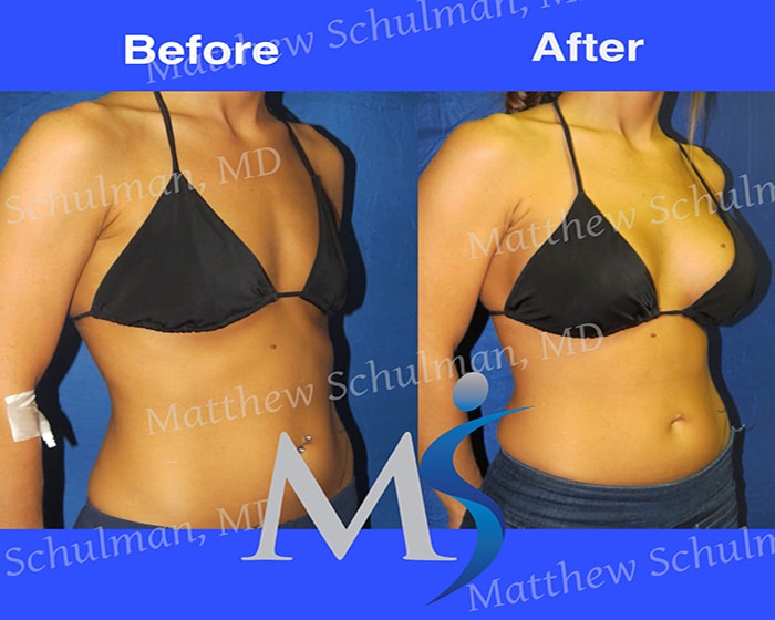 Breast Augmentation New York City