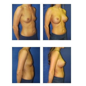 Breast Augmentation Procedure