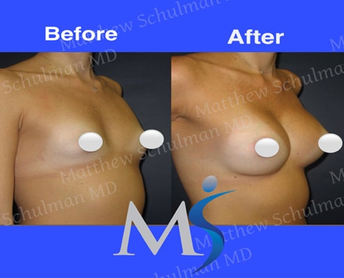 Breast Augmentation in NYC