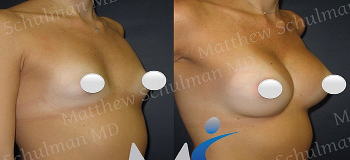 Breast Augmentation in NYC