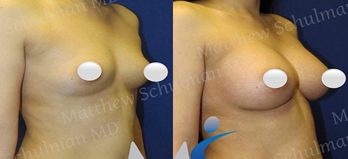 Breast Augmentation in New York City
