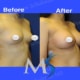 Breast Augmentation in New York City