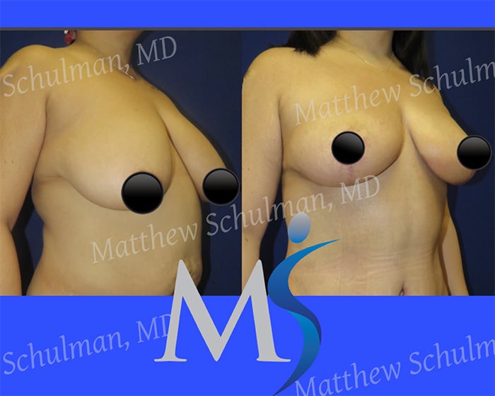 Breast Lift New York City Before and After
